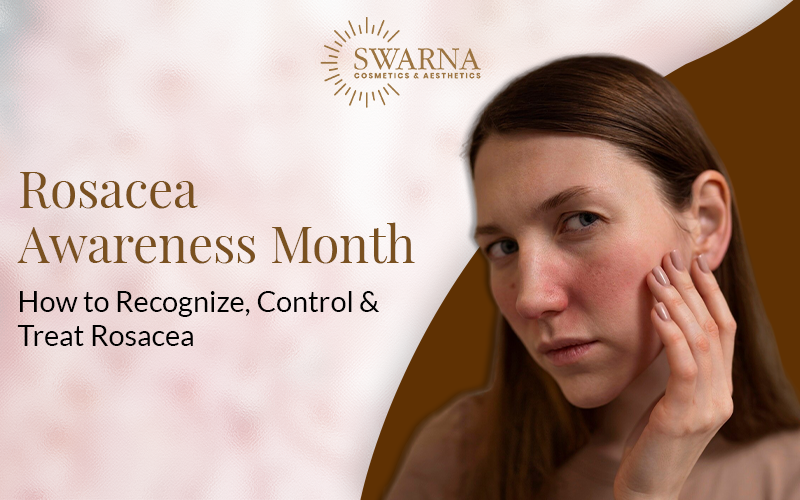 Rosacea Awareness Month: Understanding, Managing & Treating Rosacea
