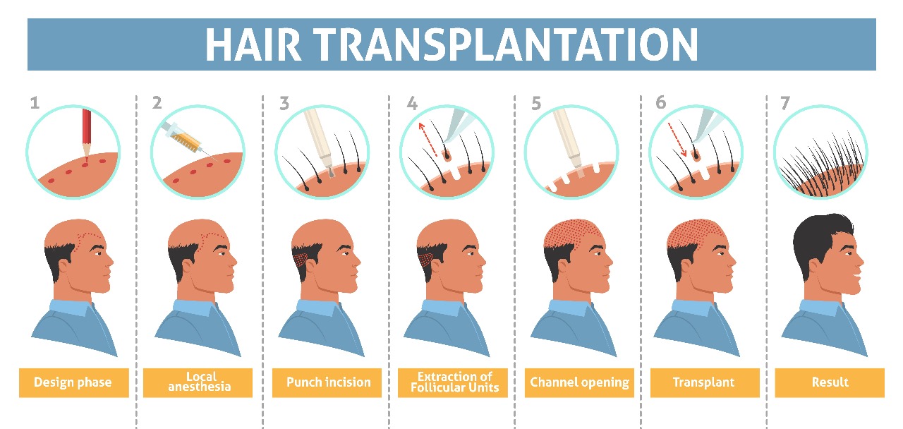 Process of Hair Transplant