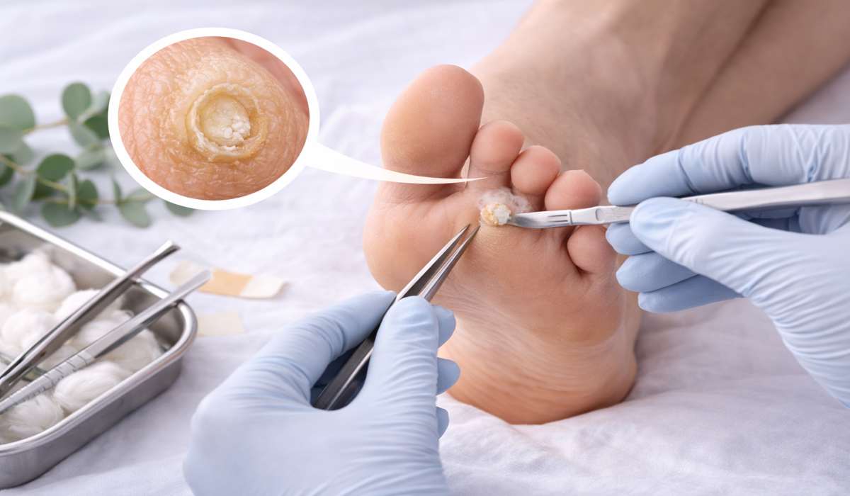 Corn Removal Surgery