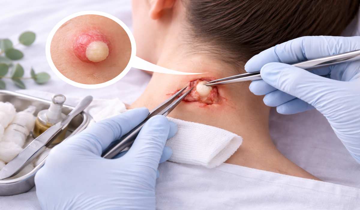 Cyst Excision Surgery