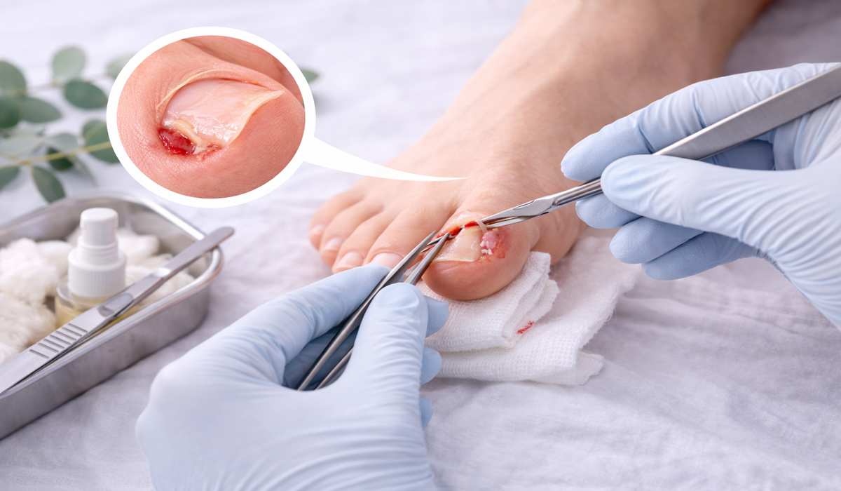Nail Surgery Treatment