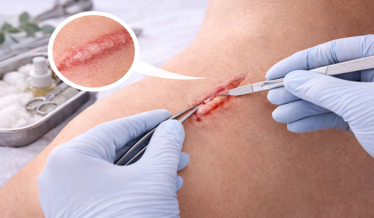 Scar Revision Surgery