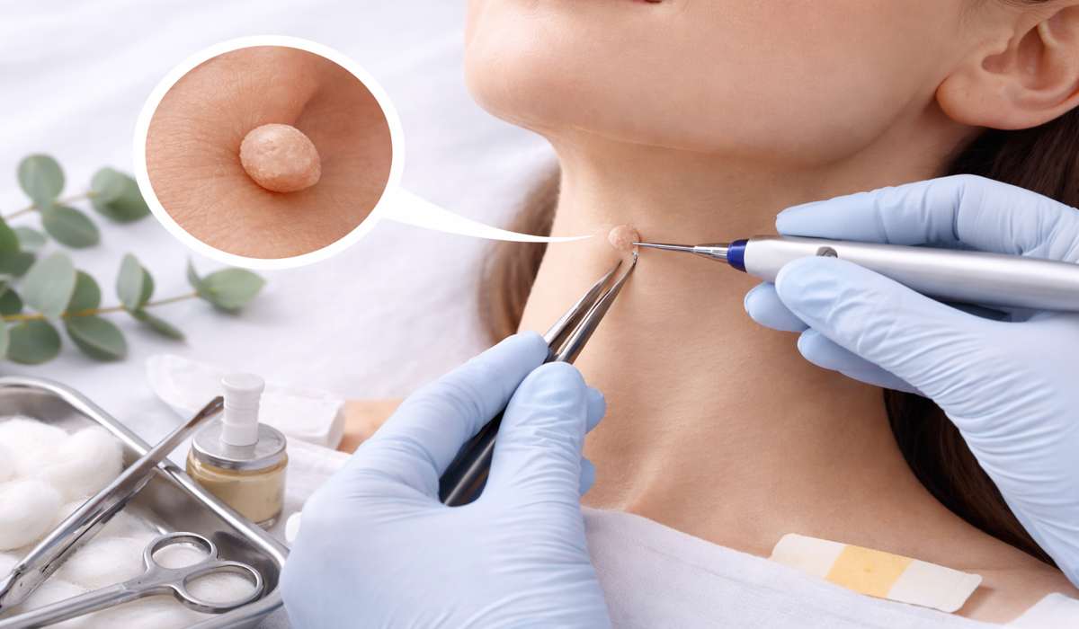 Skin Tag Removal jaipur