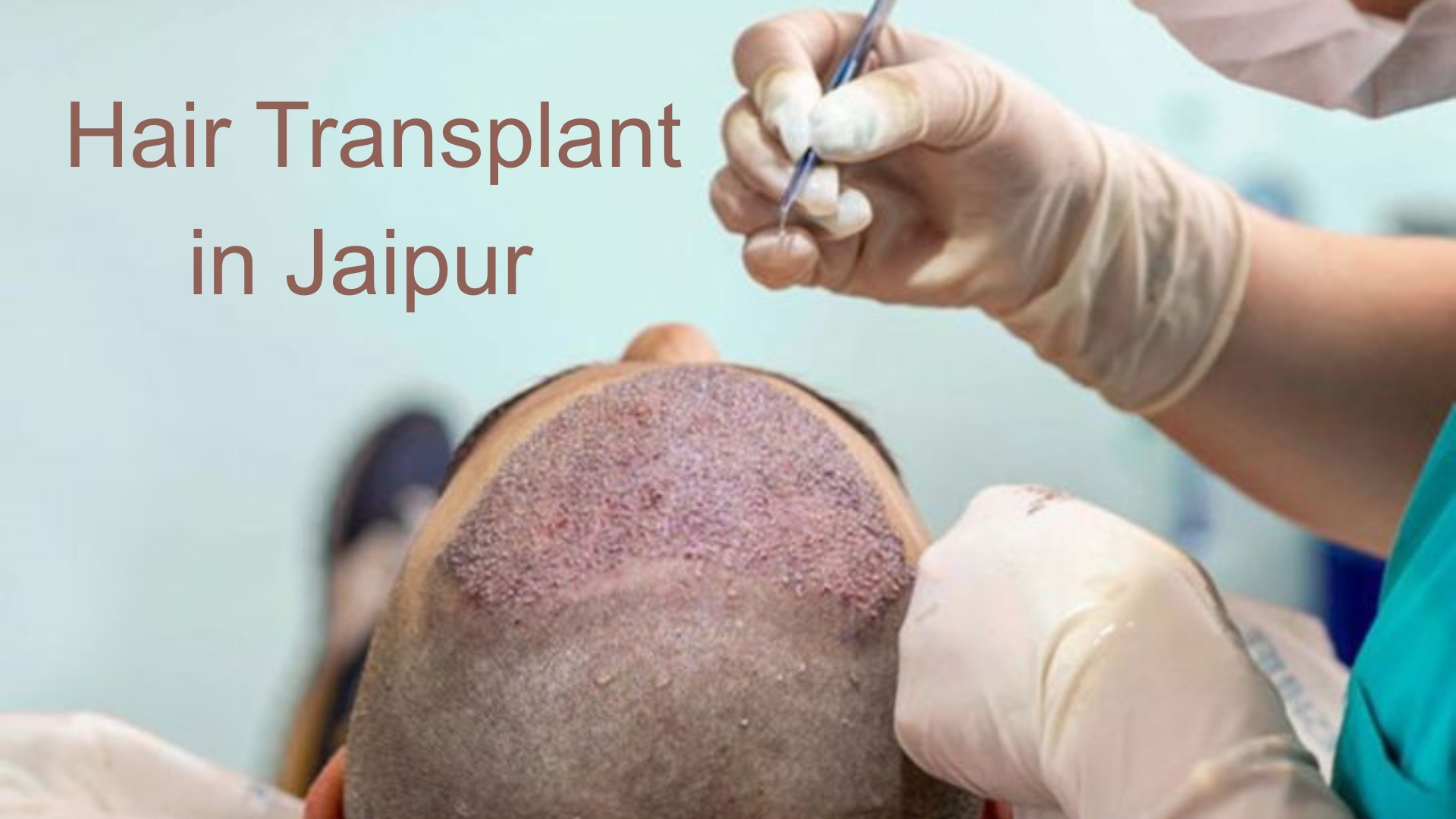 Hair Transplant in Jaipur