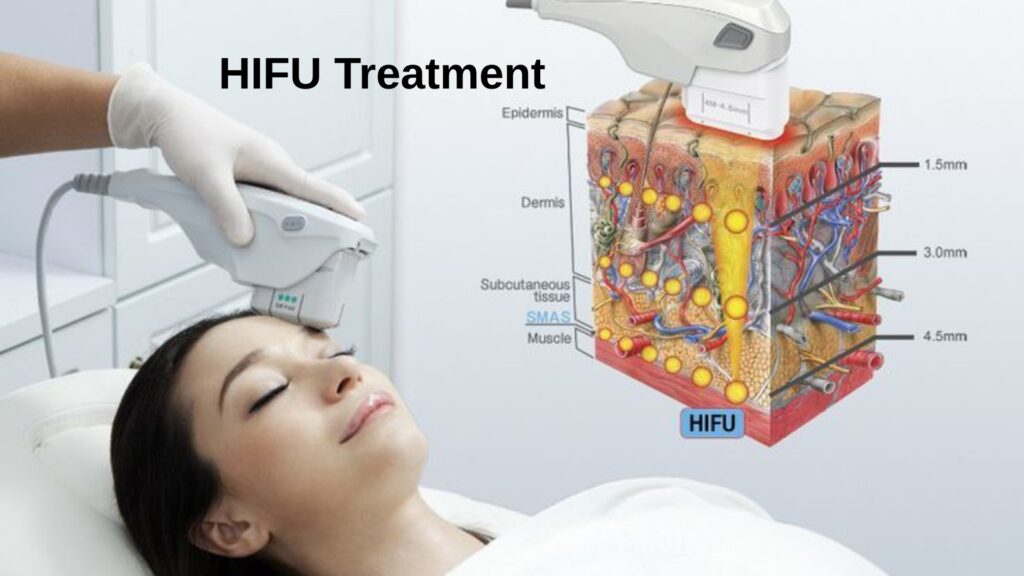 HIFU Treatment