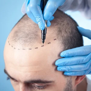 Hair+Transplant+Timeline+-+Hairline