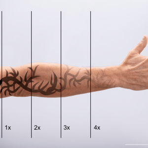 Laser-Tattoo-Removal-Process-chicago